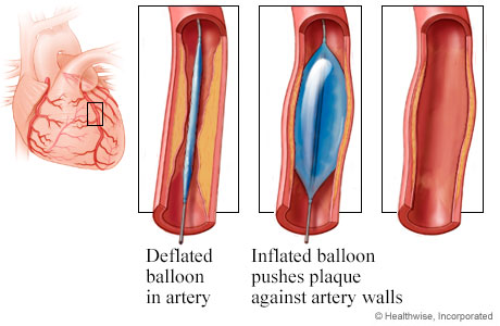 Deflated and inflated balloon in narrowed artery, and widened artery