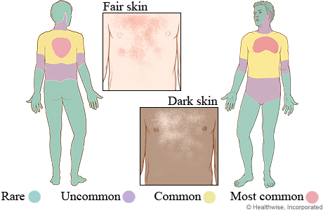 Tinea versicolor on fair skin and dark skin, and where it occurs on the body