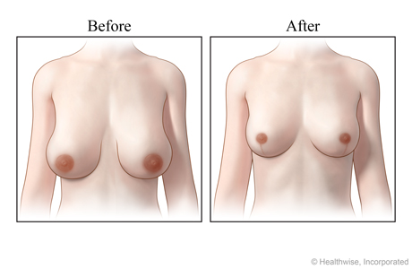Views of breasts, before and after a breast reduction