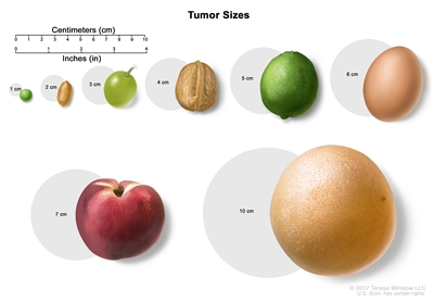 Tumor sizes; drawing shows different sizes of a tumor compared to the size of a pea (1 cm), peanut (2 cm), grape (3 cm), walnut (4 cm), lime (5 cm), egg (6 cm), peach (7 cm), and grapefruit (10 cm).