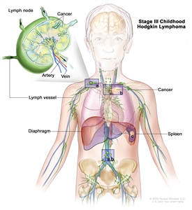 Stage III childhood Hodgkin lymphoma; drawing shows cancer in lymph node groups above and below the diaphragm, in the left lung, and in the spleen. An inset shows a lymph node with a lymph vessel, an artery, and a vein. Lymphoma cells containing cancer are shown in the lymph node.