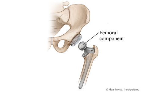 Hip replacement: Step 3 - Femoral component is placed