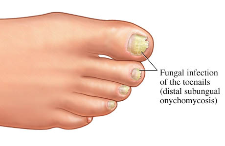 Picture of fungal nail infection