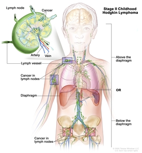 Stage II childhood Hodgkin lymphoma; drawing shows cancer in lymph node groups above and below the diaphragm. An inset shows a lymph node with a lymph vessel, an artery, and a vein. Lymphoma cells containing cancer are shown in the lymph node.