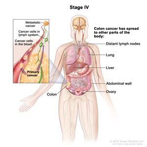 Stage IV colon cancer; drawing shows other parts of the body where colon cancer may spread, including the distant lymph nodes, lung, liver, abdominal wall, and ovary. An inset shows cancer cells spreading from the colon, through the blood and lymph system, to another part of the body where metastatic cancer has formed.
