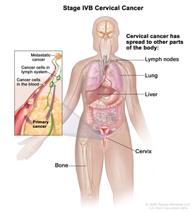 Stage IVB cervical cancer; drawing shows other parts of the body where cervical cancer may spread, including the lymph nodes, lung, liver, and bone. An inset shows cancer cells spreading from the cervix, through the blood and lymph system, to another part of the body where metastatic cancer has formed.