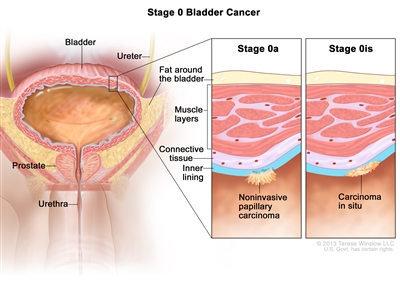 Stage 0 bladder cancer; drawing shows the bladder, ureter, prostate, and urethra. First inset shows stage 0a (also called noninvasive papillary carcinoma) on the inner lining of the bladder. Second inset shows stage 0is (also called carcinoma in situ) on the inner lining of the bladder. Also shown are the layers of connective tissue and muscle tissue of the bladder and the layer of fat around the bladder.